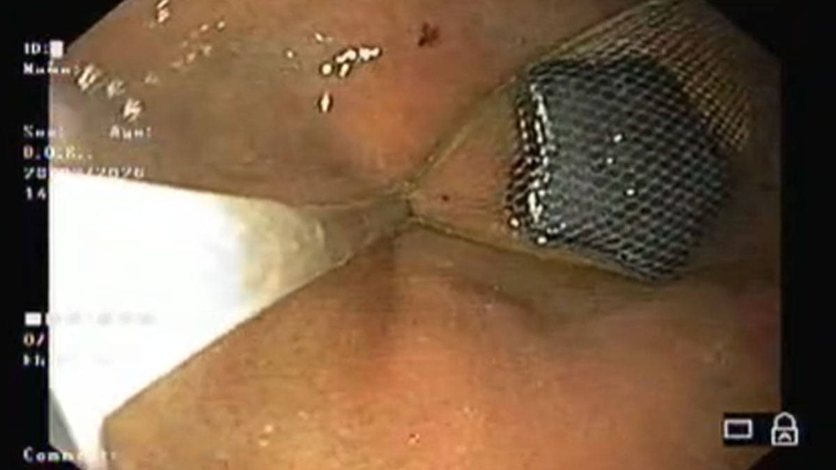 Chandrapur: डॉक्टर की सूझबूझ, बिना बेहोश किए एंडोस्कोपी से निकाला बच्चे के पेट से चुंबक